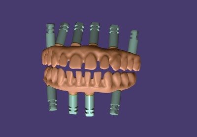 EXOCAD – Most na implantatih