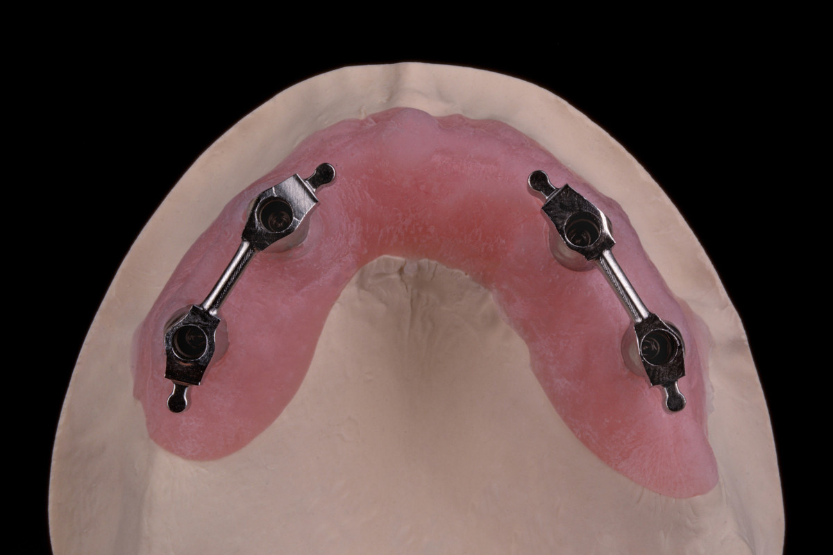 gredi-na-implantatih/CoCr-gred-na-implantatih
